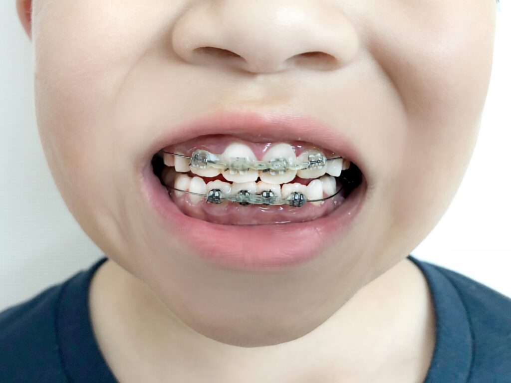 子どもの矯正した歯の写真